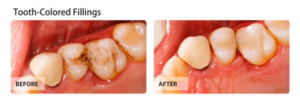 Before and after tooth-colored fillings.