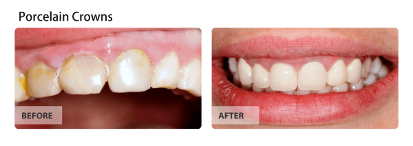 Before and after porcelain crowns treatment.