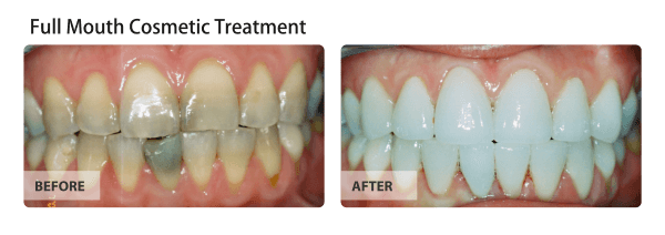 Before and after a full mouth cosmetic treatment.