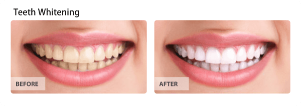Before and after a professional teeth whitening treatment.