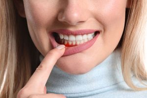 patient showing red, bleeding gums