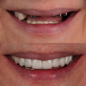 missing teeth restored with dental implants