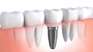 dental implant